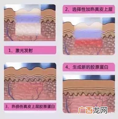 医美改善毛孔粗大,哪些医美项目可以收缩毛孔