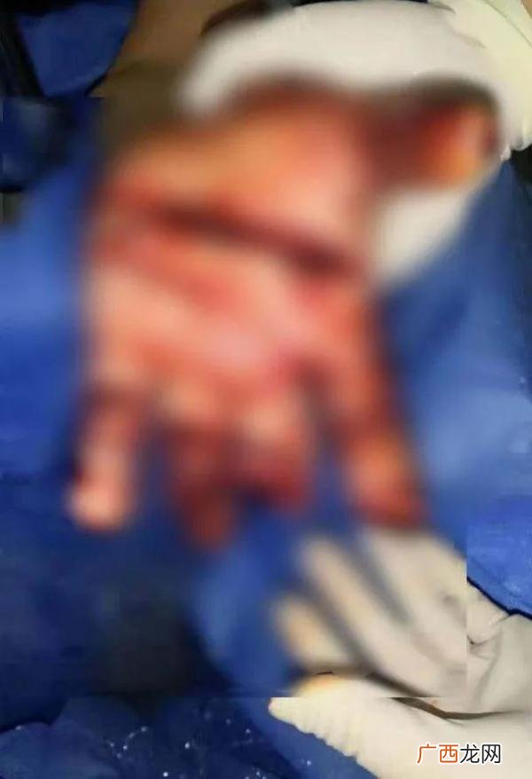 掉两个手指算几级伤残 手指头断了两根算几级伤残