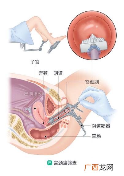 宫颈癌筛查前多久不能同房 女性两癌筛查前后注意事项