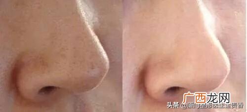 医美最基本的有哪些项目 医美项目有哪些